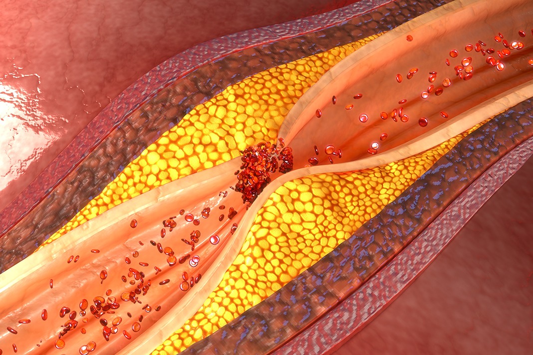 Study Reveals Periodontal Diseases And Coronary Artery Disease Share 