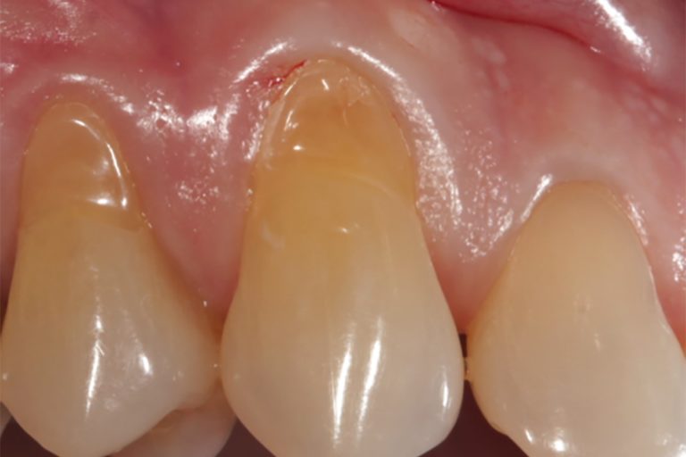 Gingival Recession: When Surgical Options Should Be Considered Instead ...