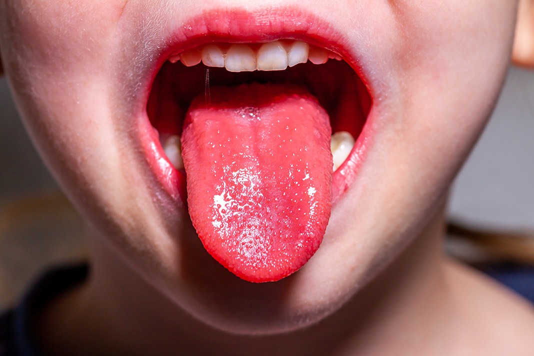 Zoo om natten underjordisk afkom Strawberry Tongue: Systemic Health Influences This Oral Health Condition -  Today's RDH