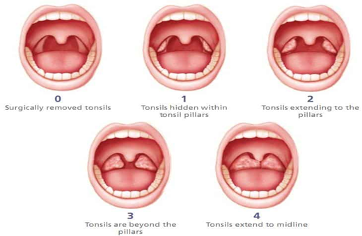 tonsils-close-scrutiny-can-pinpoint-disease-and-raise-oral-health