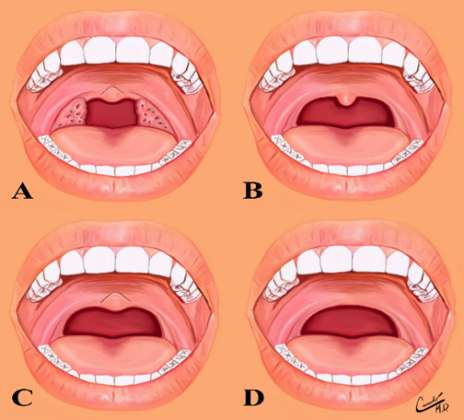 The Uvula: Conditions that Dental Hygienists can Observe during an Exam ...