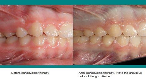 Tooth Staining Awareness Of Oral Health Effects Of Tetracycline And Minocycline Today S Rdh