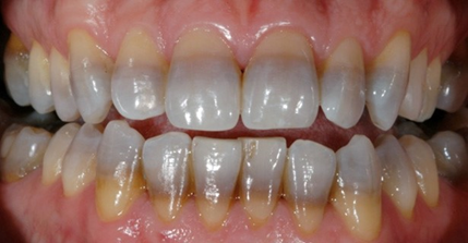 Tooth Staining Awareness Of Oral Health Effects Of Tetracycline And Minocycline Today S Rdh