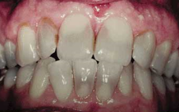 Tooth Staining: Awareness of Oral Health Effects of Tetracycline and