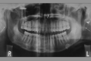 Eagle Syndrome How RDHs Can Distinguish It From TMD Today S RDH