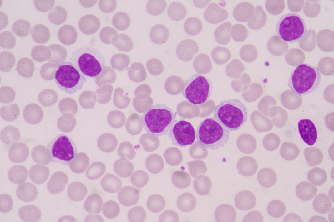 Oral Myeloid Sarcoma Lesions Linked to Acute Myeloid Leukemia - Today's RDH