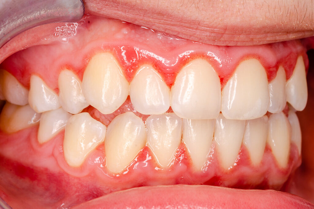 Desquamative Gingivitis Maintenance through Proper Oral Care In Lieu